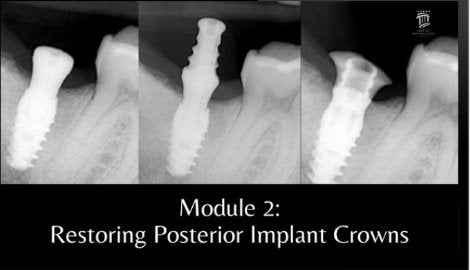 Implant Restorations Simplified: Restore Dental Implants with Accuracy & Confidence (Surgical Master)