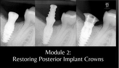 Implant Restorations Simplified: Restore Dental Implants with Accuracy & Confidence (Surgical Master)