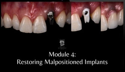 Implant Restorations Simplified: Restore Dental Implants with Accuracy & Confidence (Surgical Master)