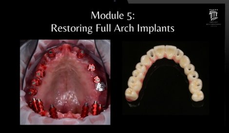 Implant Restorations Simplified: Restore Dental Implants with Accuracy & Confidence (Surgical Master)