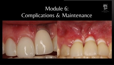 Implant Restorations Simplified: Restore Dental Implants with Accuracy & Confidence (Surgical Master)