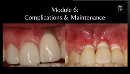 Implant Restorations Simplified: Restore Dental Implants with Accuracy & Confidence (Surgical Master)